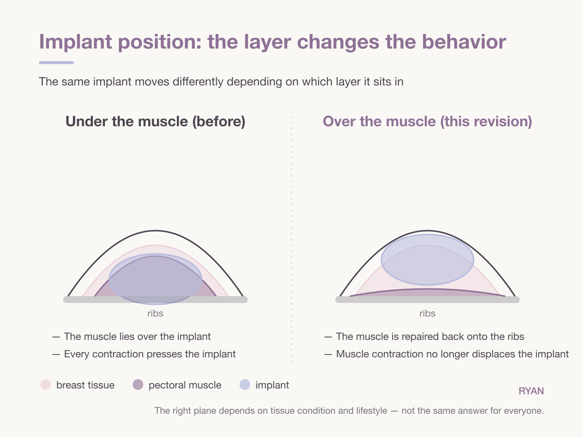 Cross-section diagram comparing breast implant under the muscle versus over the muscle with the pectoral muscle repaired onto the ribs