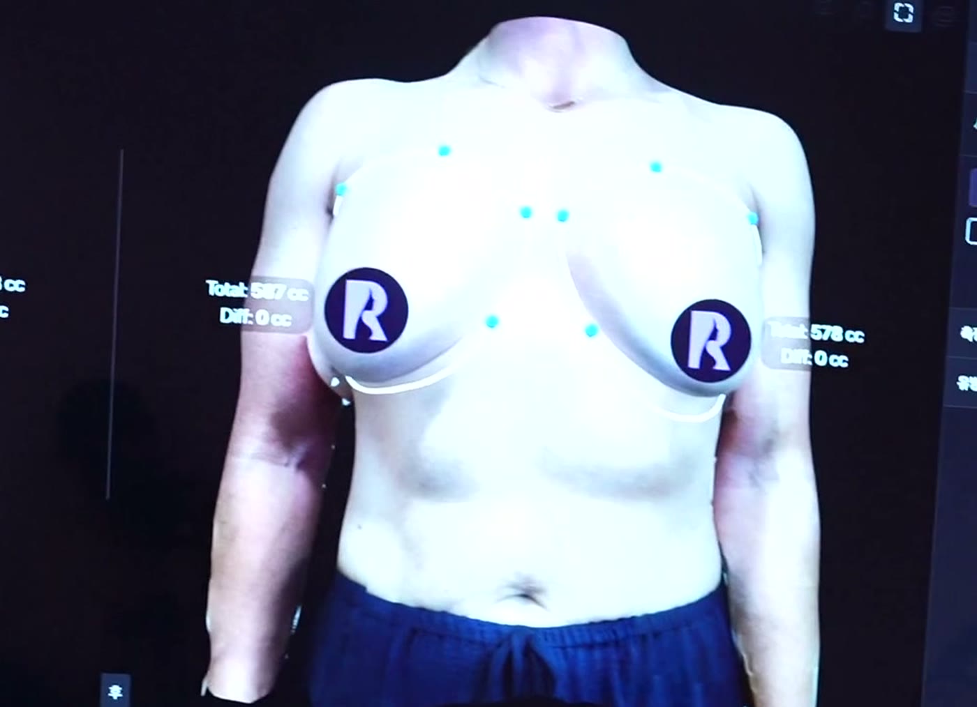 3D simulation screen used to compare breast implant volumes during consultation