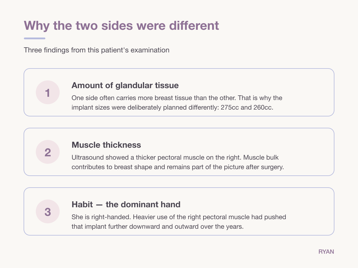 Diagram: three causes of breast asymmetry found in this examination - glandular tissue amount, muscle thickness, dominant hand