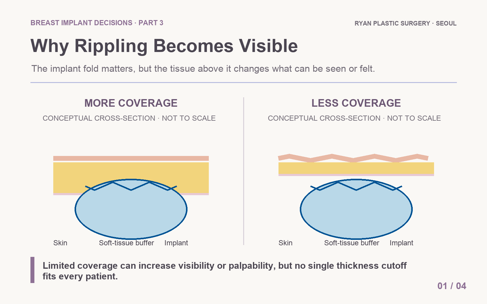 Conceptual cross-section comparing more and less soft-tissue coverage over a rippling breast implant
